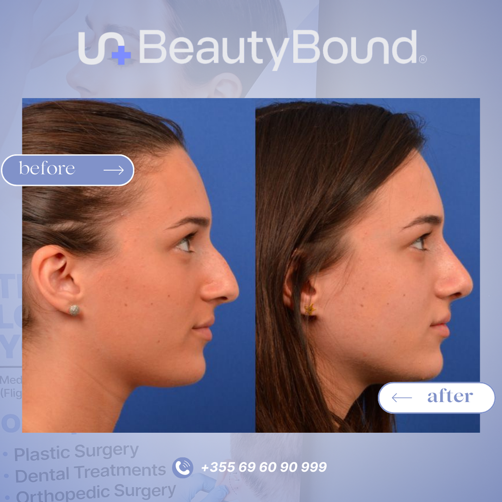 Before and After Result