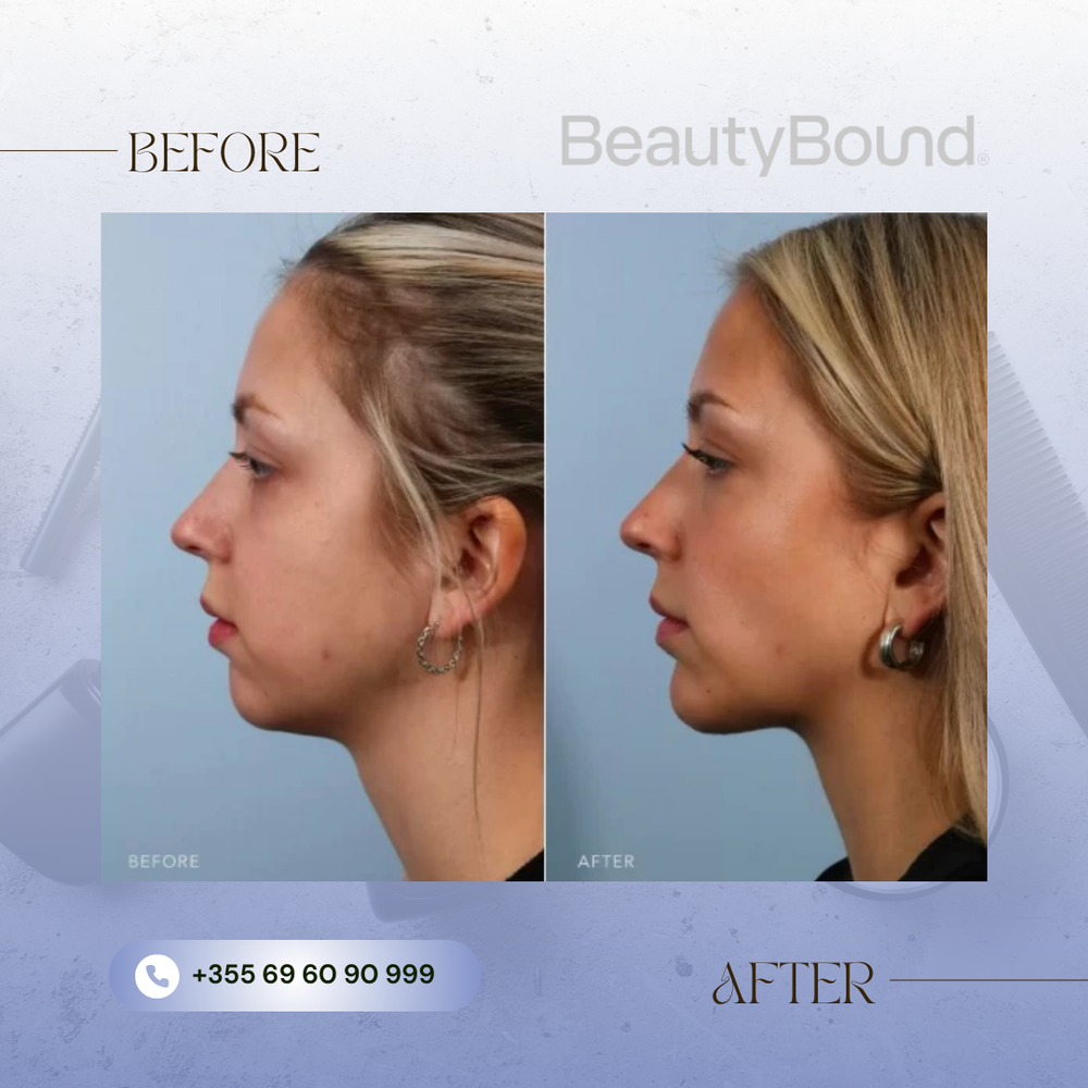 Before and After Result