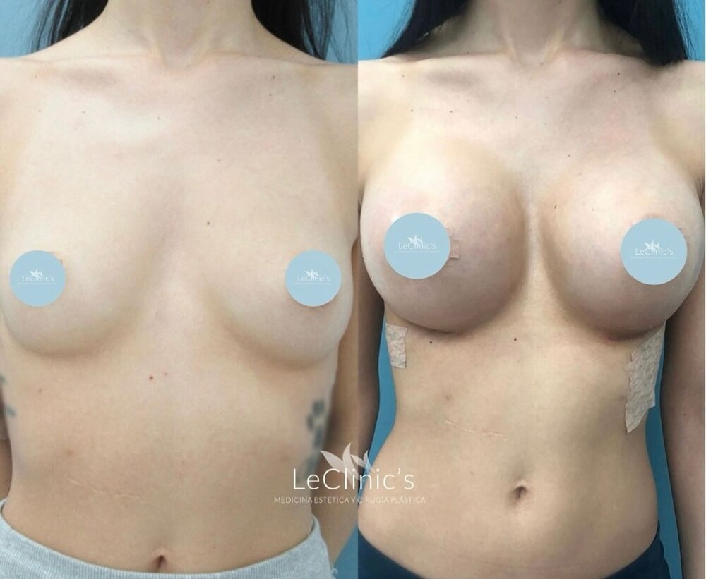 Before and After Result