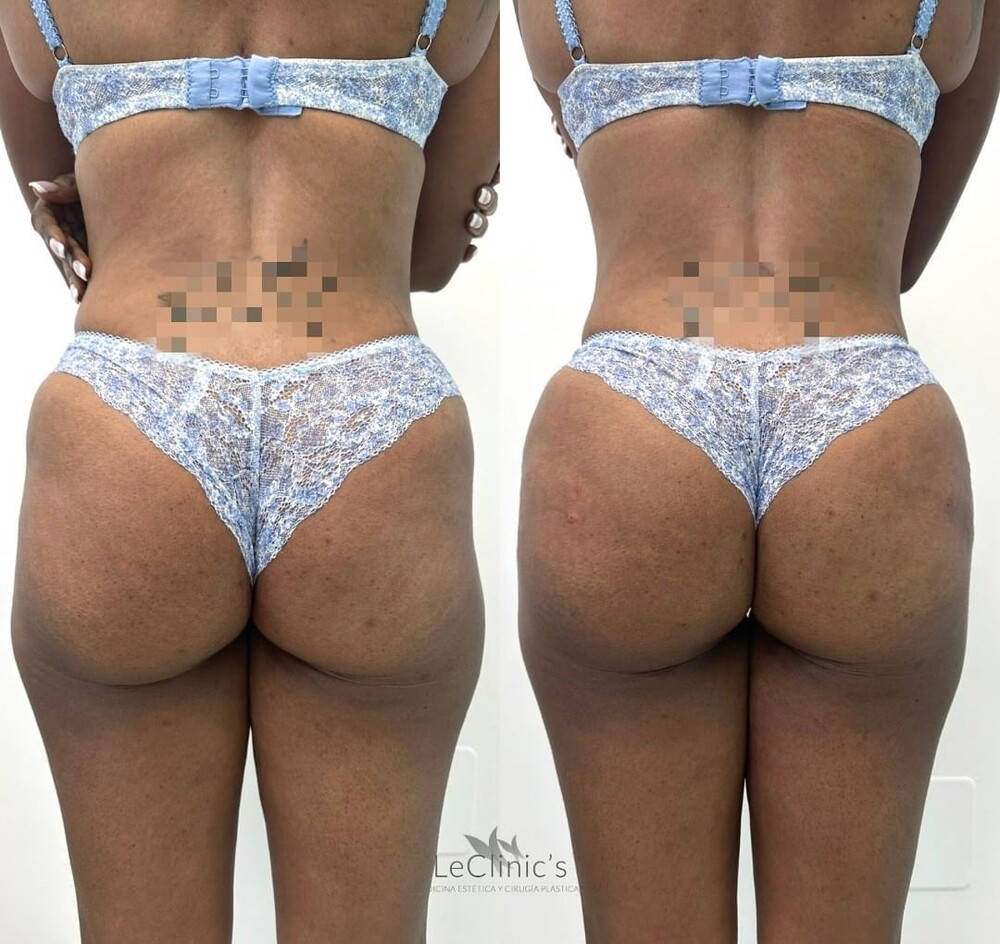 Before and After Result