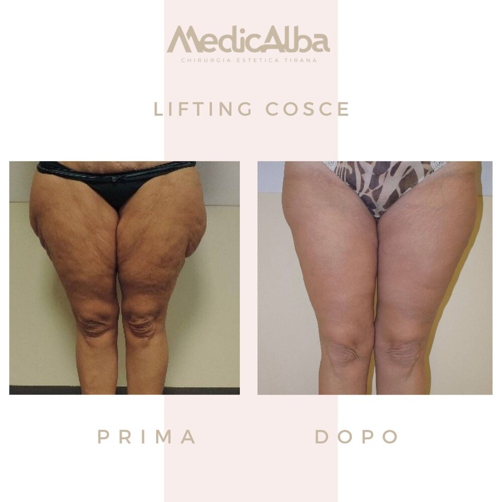 Before and After Result