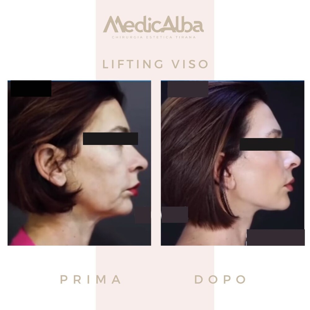 Before and After Result